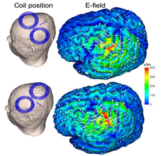 Brain surface and DT